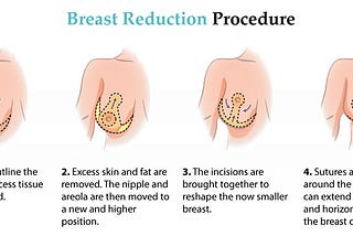 Breast Reduction Surgery — What it is, Benefits, Procedure, Risks and Much More