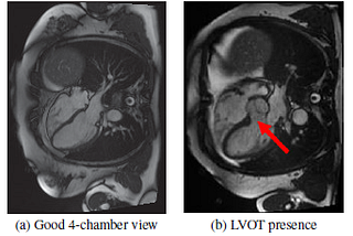 Brief Review — Automatic Left Ventricular Outflow Tract Classification for Accurate Cardiac MR…