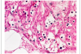 Mucormycosis : Rare fungal infection linked to corona virus