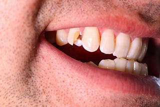 Cracked Teeth: Causes, Symptoms, Prevention Strategies, and Remedies
