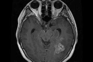 Brain Tumour Classification using Convolutional Neural Networks