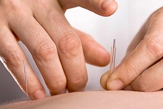 Benefits Of Fertility Acupuncture.