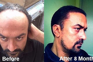 Best Hair Transplant Method: The Key Benefit To Hair Loss In 2021