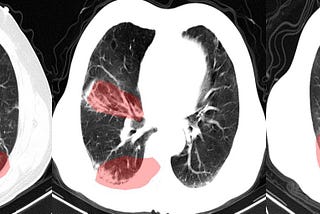 COVIDNET-CT: a new model for CT scans