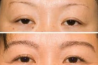 What is the cost of an eyebrow transplant in India?