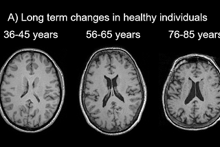 Brain changes over the lifespan.