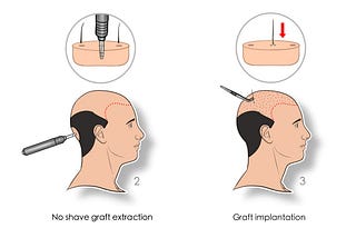 How Much Do Hair Implants Cost in Turkey?