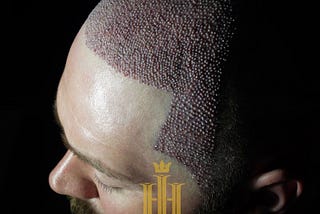 FUE Hair Transplant Explained: What Is FUE Hair Transplant?