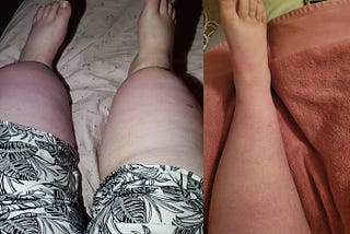 Half a Year on Compounded Tirzepatide