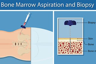 Improving Patient Experience During Bone Marrow Biopsies