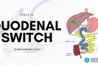 What is duodenal switch surgery with procedure diagram