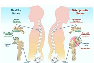 Pilates and Yoga Are Cute – But They Won’t Cure Your Osteoporosis