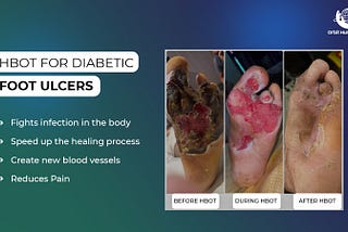 Healing Diabetic Foot Ulcers with Hyperbaric Oxygen Therapy