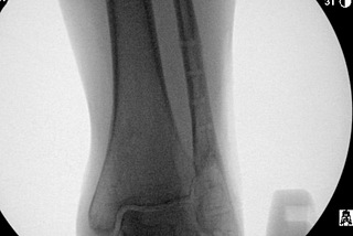 Broken Ankle at 13 months
