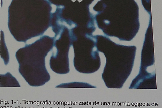 Anatomia, embriología y fisiología quirúrgica de la nariz y los senos paranasales