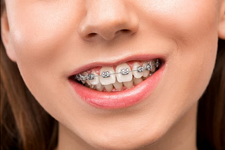 Choosing the Right Braces in Miami, FL: A Guide to Orthodontic Options