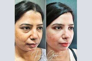 What is Single Eyelid or Double Eyelid Surgery?