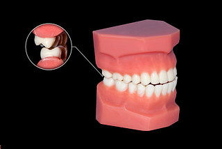 What are the other options aside from both extracting decayed first molarsAlternatives to Extracting Decayed First Molars