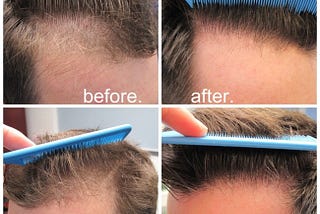 Flaunt Naturally Growing Hair with Hair Transplant
