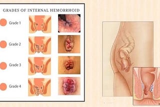 Health Talk: Hemorrhoids (Piles)