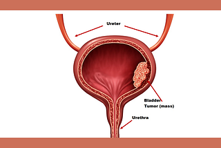 My Journey Through Bladder Cancer