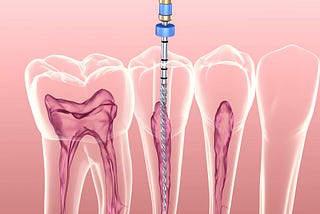 Unlocking the Truth About Root Canal Treatment