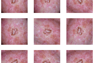 Skin Cancer Detection Using Convolutional Neural Networks