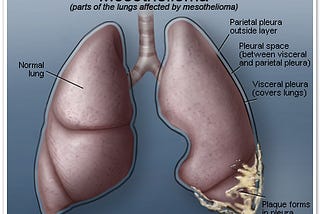 Understanding Mesothelioma