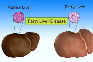 Beware of the Fatty Liver Disease Sign by Dr. Sushrut Singh