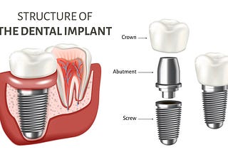 What should you know about Dental implants?