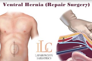 Ventral Hernia Treatment in Indore, Ventral Hernia Surgeon Indore | Dr. Achal Agrawal