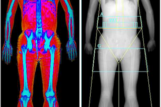 A tale of two DEXA scans