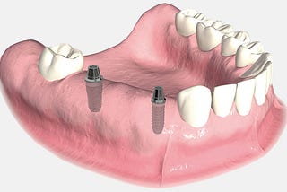 Why Dental Implants Are Superior to Any Other Replacement Teeth