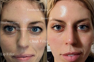 heidi bitton plastic surgery by dr charbel medawar before and after