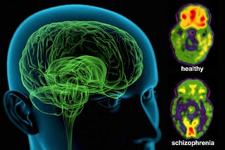 Schizophrenia Misunderstood: The Unwanted Population