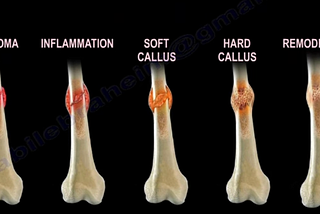 Optimizing Fracture Healing: Advanced Medical Strategies and Emerging Technologies