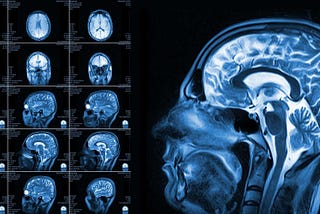 Deep Brain Stimulation for Schizophrenia
