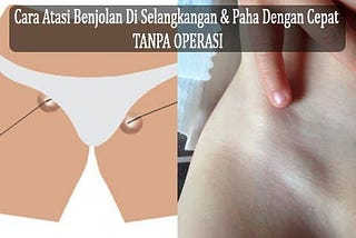 Cara Mengobati Sekelan, Mengobati Sekelan Dengan Cepat, Obat Sekelan Alami Di Apotik / Apotek 100%…