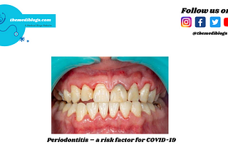 Periodontitis — themediblogs|best medical blogs website