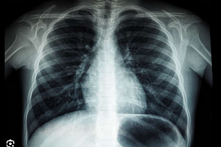 AI-Powered Pneumonia Detection Using Chest X-rays