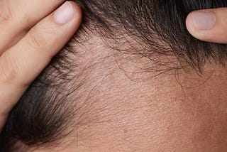 The Leading Causes of Premature Hair Loss: A Professional Approach