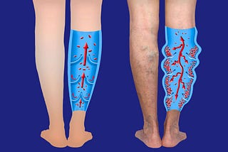 Understanding Varicose Veins: Causes, Symptoms, and Treatment Options