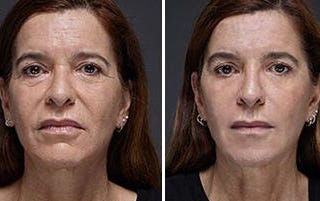 Rejuvenate 12 years in 2 weeks, naturally! No Botox or plastic surgery