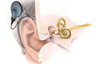 3D Cochlear Implant Surgery