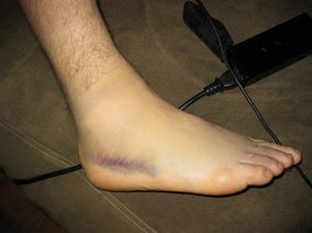 Heal A Sprained Ankle Fast: Secret Exercise The Doc Won’t Tell You About