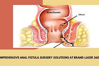 Comprehensive Anal Fistula Surgery Solutions at Brand-Laser 360 Clinic