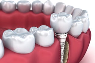 Dental Implants — What You Need to Know