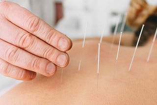 acupuncture for lower back pain