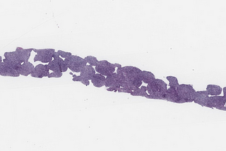 DLBCL, EBV-Positive