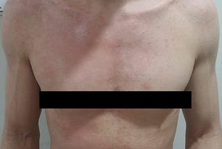 Lessons from Topical Steroid Withdrawal